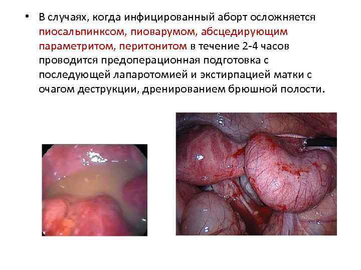  • В случаях, когда инфицированный аборт осложняется пиосальпинксом, пиоварумом, абсцедирующим параметритом, перитонитом в