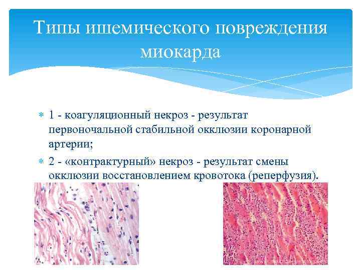 Типы ишемического повреждения миокарда 1 - коагуляционный некроз - результат первоночальной стабильной окклюзии коронарной