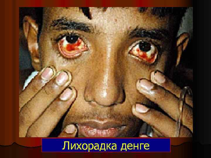 Лихорадка денге 