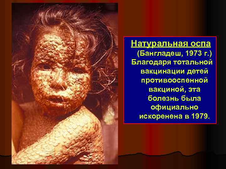 Натуральная оспа (Бангладеш, 1973 г. ) Благодаря тотальной вакцинации детей противооспенной вакциной, эта болезнь