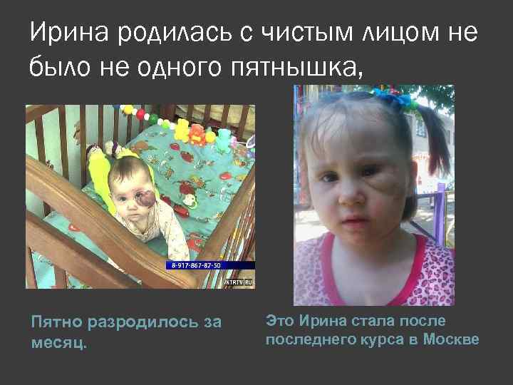 Ирина родилась с чистым лицом не было не одного пятнышка, Пятно разродилось за месяц.