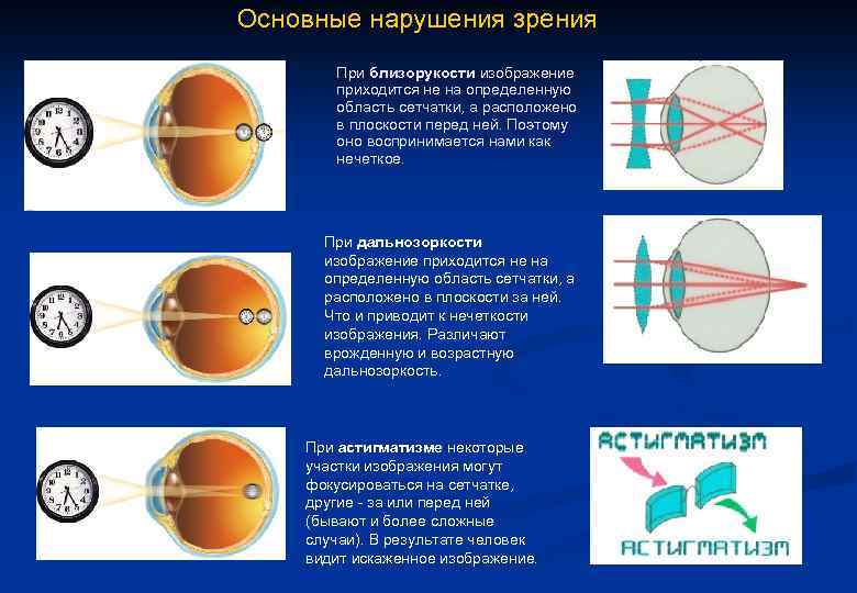 Рассмотрите рисунок сравните близорукость и дальнозоркость ответы занесите в таблицу