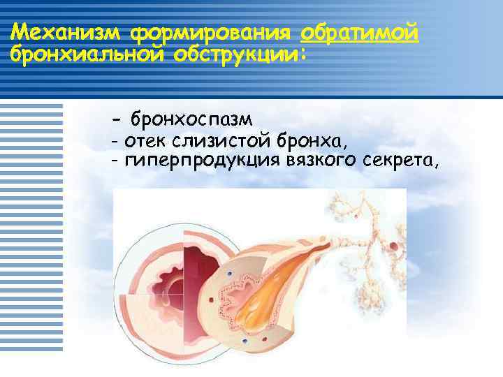 Механизм формирования обратимой бронхиальной обструкции: - бронхоспазм - отек слизистой бронха, - гиперпродукция вязкого