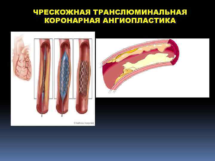 Транслюминальная баллонная ангиопластика. ТРАНСЛЮМИНАЛЬНАЯ коронарная ангиопластика. ТРАНСЛЮМИНАЛЬНАЯ баллонная ангиопластика коронарных артерий. ТРАНСЛЮМИНАЛЬНАЯ баллонная ангиопластика почечной артерии. Транслюмбальная аортопластика коронарных артерий.