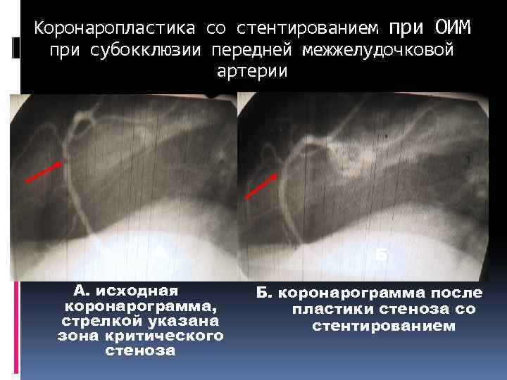 Коронаропластика со стентированием при ОИМ при субокклюзии передней межжелудочковой артерии А А. исходная коронарограмма,