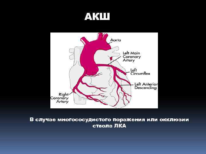 АКШ В случае многососудистого поражения или окклюзии ствола ЛКА 