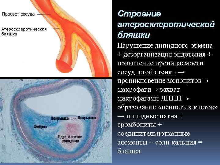 Структура атеросклеротической бляшки. Проницаемость стенок сосудов. Повышение проницаемости сосудистой стенки.