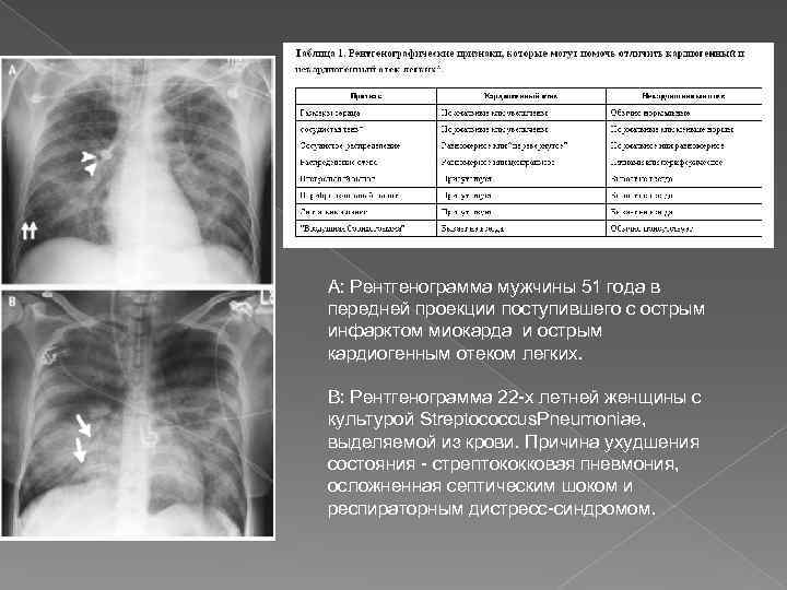 Острая сердечная недостаточность карта вызова