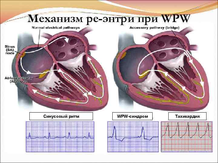 Механизм ре-энтри при WPW Синусовый ритм WPW-синдром Тахикардия 