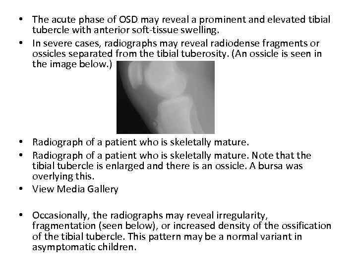  • The acute phase of OSD may reveal a prominent and elevated tibial