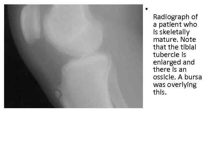  • Radiograph of a patient who is skeletally mature. Note that the tibial