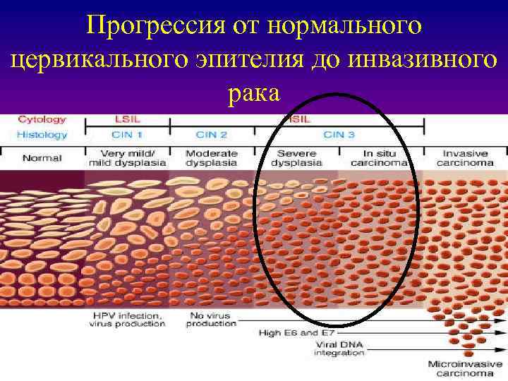 Прогрессия от нормального цервикального эпителия до инвазивного рака 