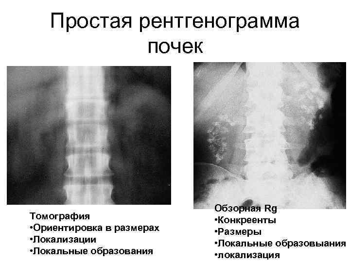 Простая рентгенограмма почек Томография • Ориентировка в размерах • Локализации • Локальные образования Обзорная