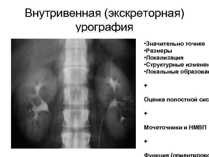 Внутривенная (экскреторная) урография • Значительно точнее • Размеры • Локализация • Структурные изменен •