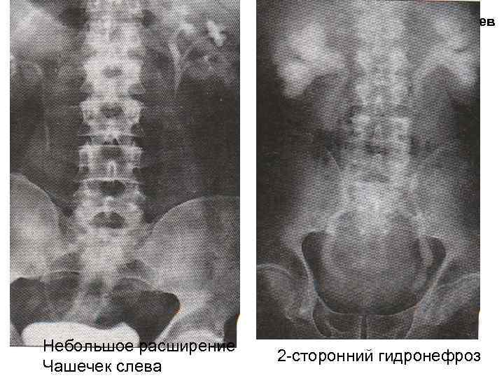 Обструкция на уровне устьев мочеточников Небольшое расширение Чашечек слева 2 -сторонний гидронефроз 
