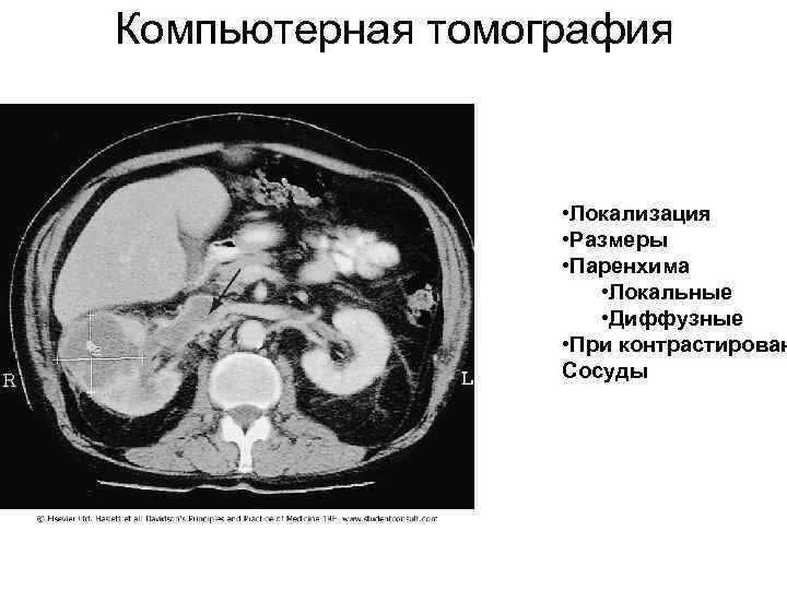 Компьютерная томография • Локализация • Размеры • Паренхима • Локальные • Диффузные • При