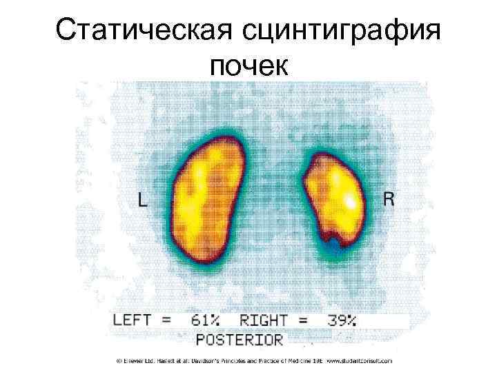 Статическая сцинтиграфия почек 