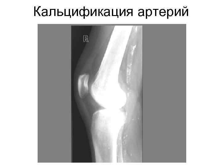 Кальцификация артерий 