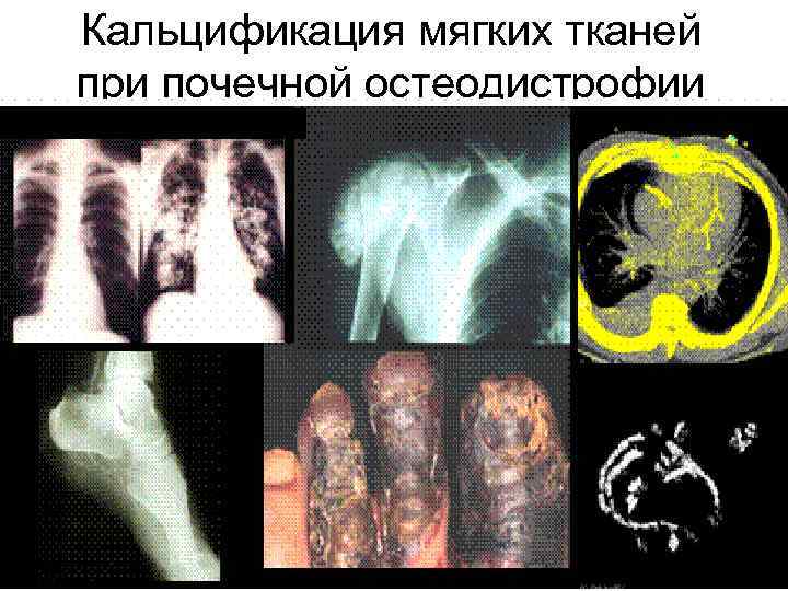 Кальцификация мягких тканей при почечной остеодистрофии 