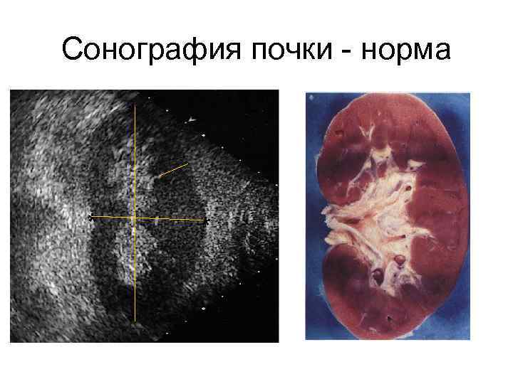 Сонография почки - норма * * 