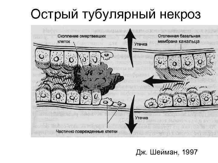 Острый тубулярный некроз Дж. Шейман, 1997 