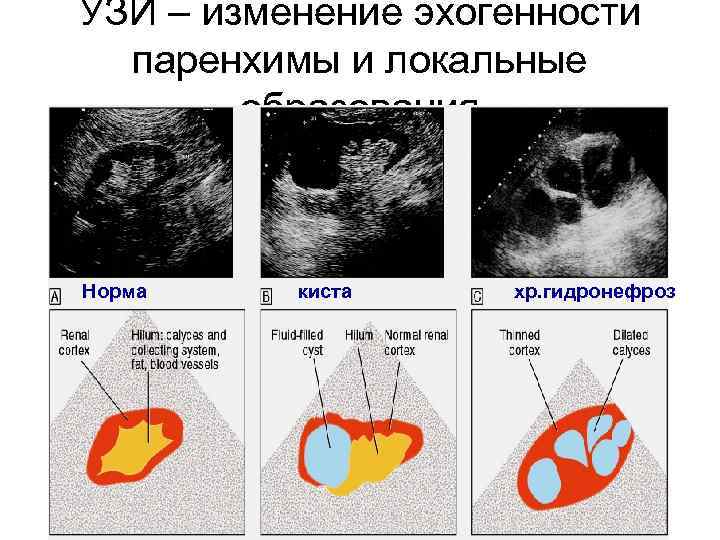 УЗИ – изменение эхогенности паренхимы и локальные образования Норма киста хр. гидронефроз 