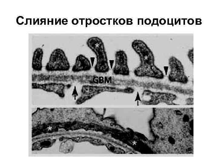 Слияние отростков подоцитов 