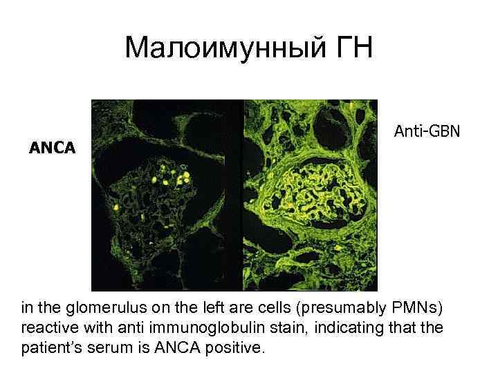 Малоимунный ГН ANCA Anti-GBN in the glomerulus on the left are cells (presumably PMNs)