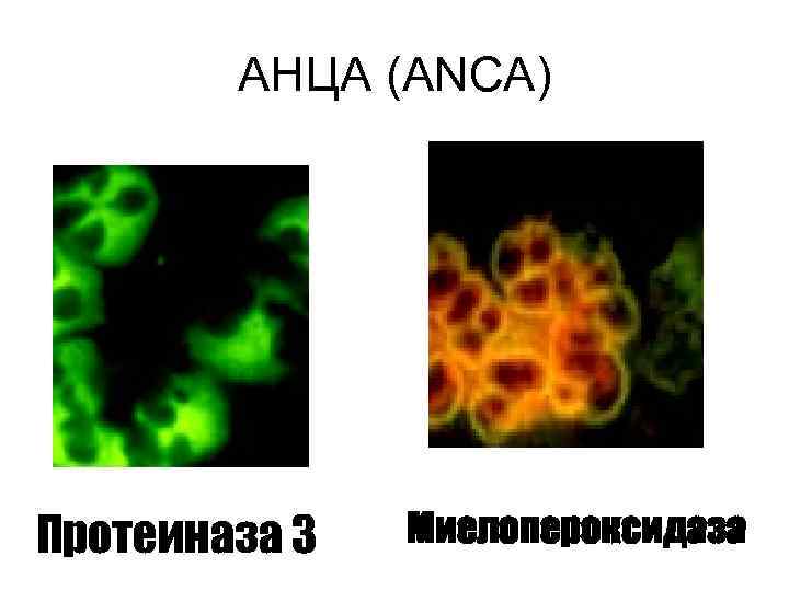 АНЦА (ANCA) Протеиназа 3 Миелопероксидаза 