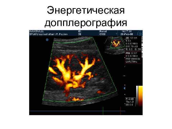 Энергетическая допплерография 