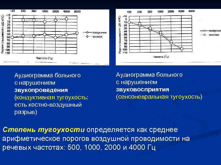 Аудиограмма больного с нарушением звукопроведения (кондуктивная тугоухость: есть костно-воздушный разрыв) Аудиограмма больного с нарушением