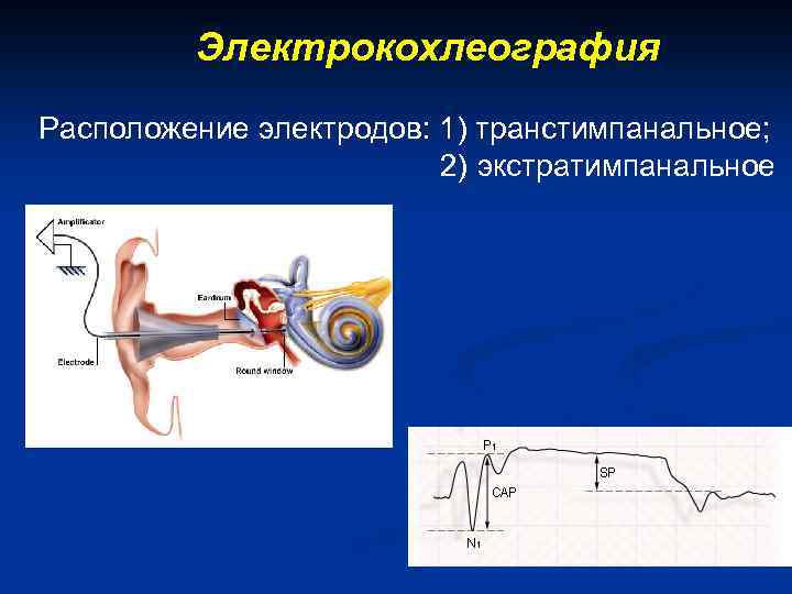 Электрокохлеография Расположение электродов: 1) транстимпанальное; 2) экстратимпанальное 
