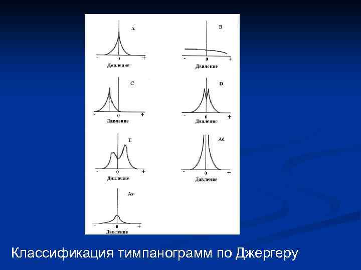 Классификация тимпанограмм по Джергеру 