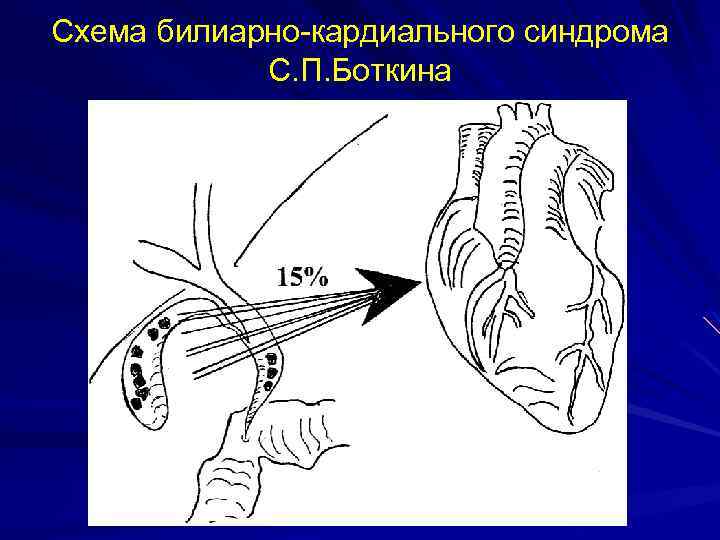 Схема билиарно-кардиального синдрома С. П. Боткина 