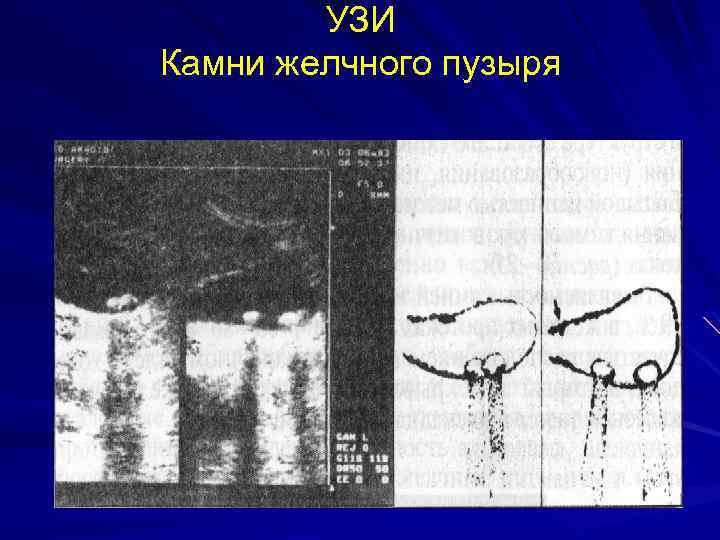 УЗИ Камни желчного пузыря 