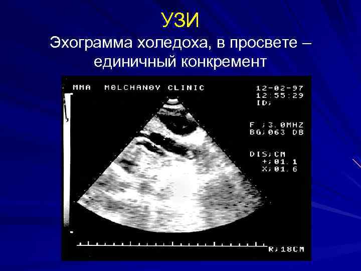 УЗИ Эхограмма холедоха, в просвете – единичный конкремент 