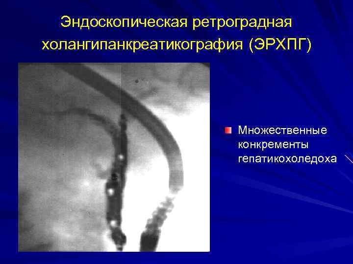 Эндоскопическая ретроградная холангипанкреатикография (ЭРХПГ) Множественные конкременты гепатикохоледоха 