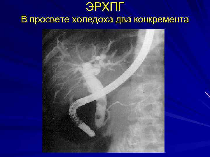 ЭРХПГ В просвете холедоха два конкремента 