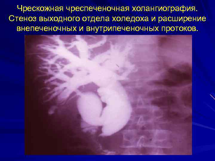 Чрескожная чреспеченочная холангиография. Стеноз выходного отдела холедоха и расширение внепеченочных и внутрипеченочных протоков. 