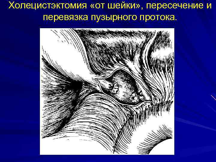 Холецистэктомия «от шейки» , пересечение и перевязка пузырного протока. 