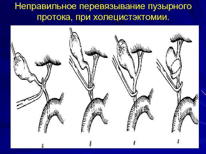 Неправильное перевязывание пузырного протока, при холецистэктомии. 