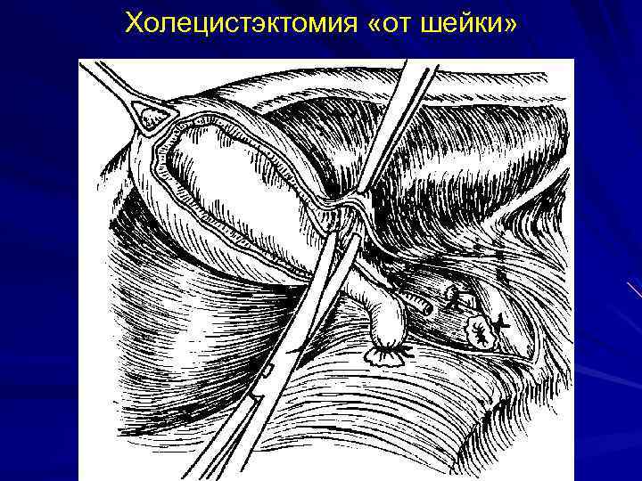 Холецистэктомия «от шейки» 