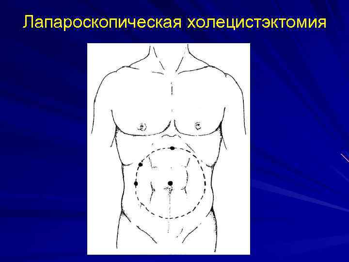 Лапароскопическая холецистэктомия 