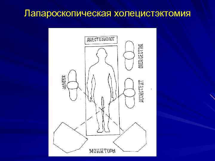 Лапароскопическая холецистэктомия 