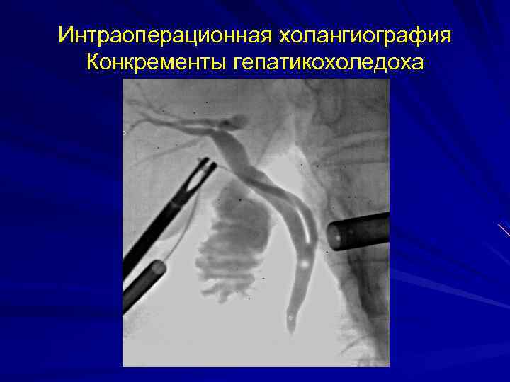 Интраоперационная холангиография Конкременты гепатикохоледоха 