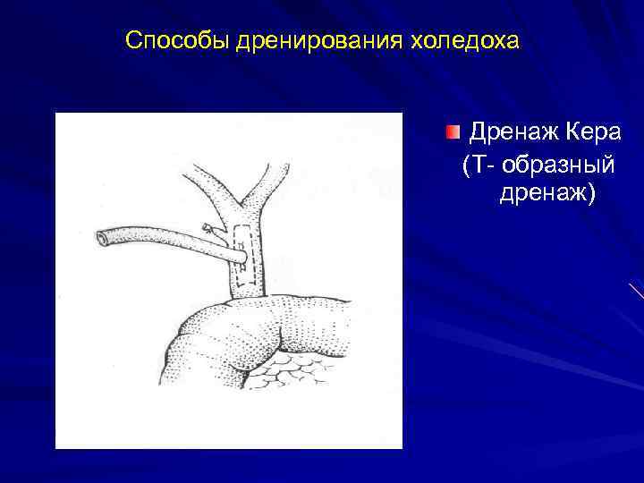 Способы дренирования холедоха Дренаж Кера (Т- образный дренаж) 