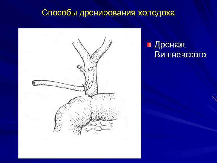 Способы дренирования холедоха Дренаж Вишневского 