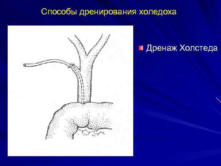 Способы дренирования холедоха Дренаж Холстеда 