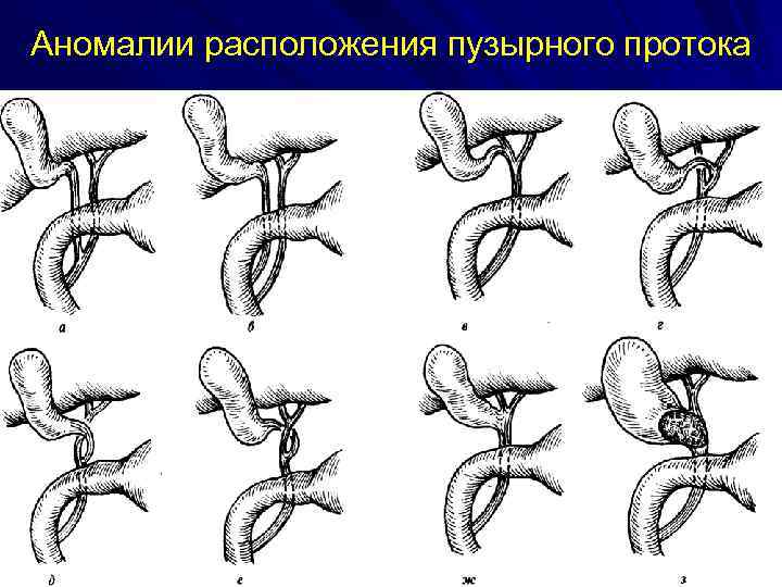 Аномалии расположения пузырного протока 