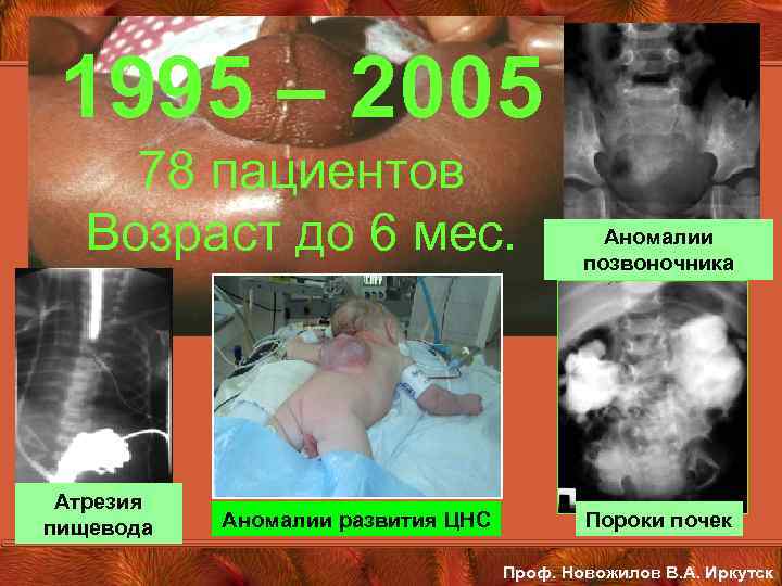 1995 – 2005 78 пациентов Возраст до 6 мес. Атрезия пищевода Аномалии развития ЦНС